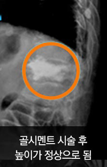 골시멘트 시술 후 높이가 정상으로 됨