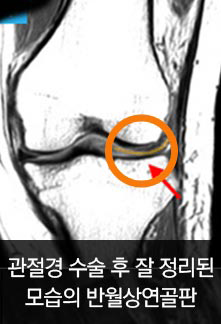 관절경 수술 후 잘 정리된 모습의 반월상연골판