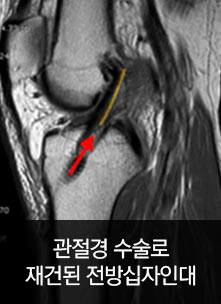 관절경 수술로 재건된 전방십자인대