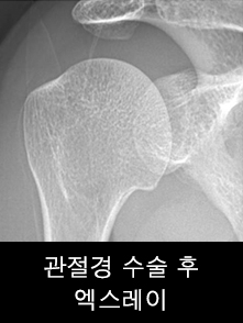 관절경 수술 후 엑스레이