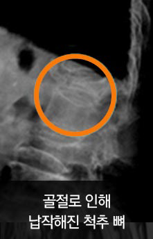 골절로 인해 납작해진 척추 뼈