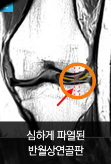 심하게 파열된 반월상연골판