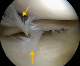 심하게 파열된 반월상연골판