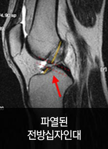 파열된 전방십자인대