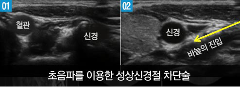 초음파를 이용한 성상신경절 차단술