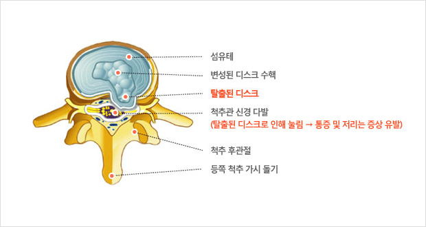 허리디스크 탈출증 설명