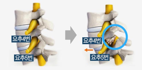 척추전방전위증 설명