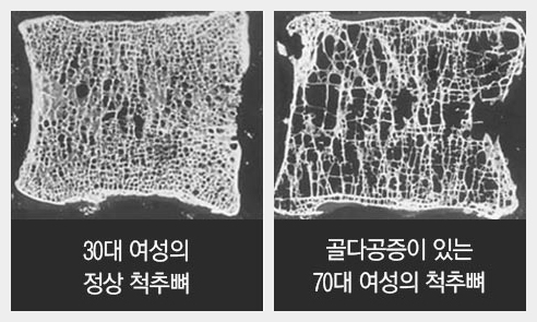 골다공증 및 척추압박골절