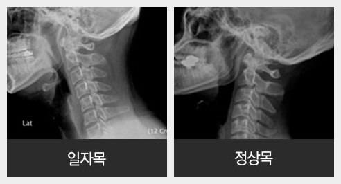 허리디스크 탈출증 설명