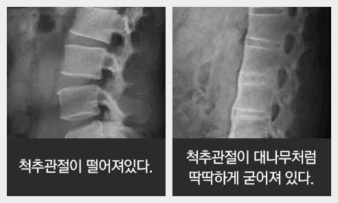 강직성 척추염