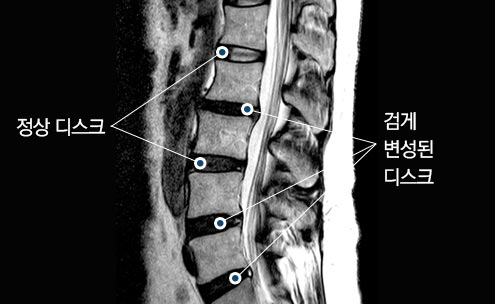 요통 및 디스크 변성증