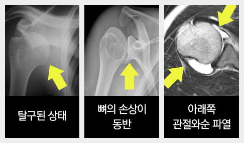 견관절탈구&관절와순파열