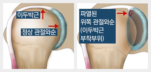 상부관절와순파열