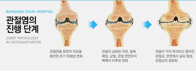 퇴행성 무릎관절염