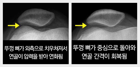 연골 연화증 치료법