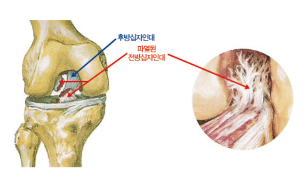 십자인대파열