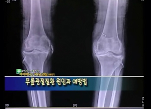 [척척박사 5회]무릎관절질환의원인과예방 